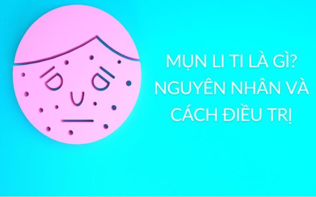 mụn li ti là gì? nguyên nhân và cách điều trị